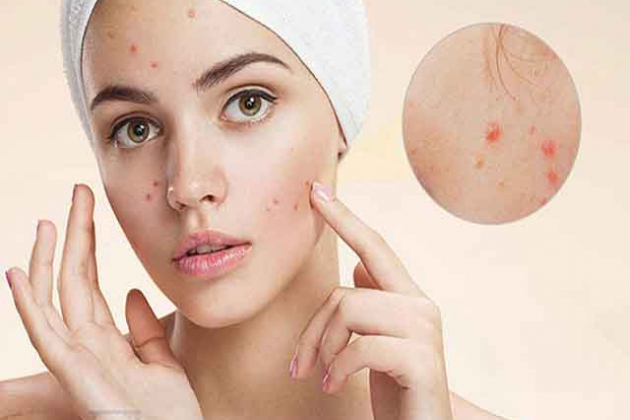 Mụn như “sủi cảo” trên mặt, sao bạn không thử những cách trị này?