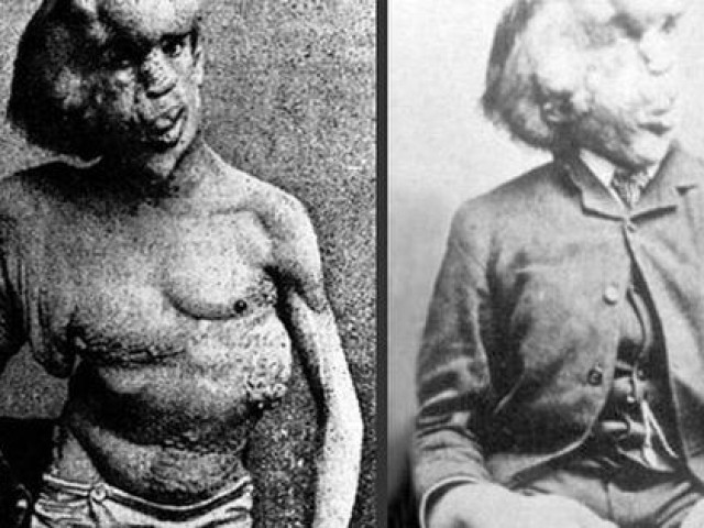 Sức khỏe đời sống - Hội chứng người voi: Nguyên nhân, triệu chứng và biện pháp điều trị