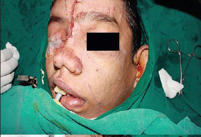 Người mắc hội chứng người voi có thể cần phẫu thuật thẩm mỹ do những biến dạng trên khuôn mặt