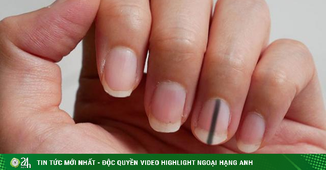 Woman stunned when she learned that the mark under her fingernails that lasted for a decade was due to cancer-Lifetime Health