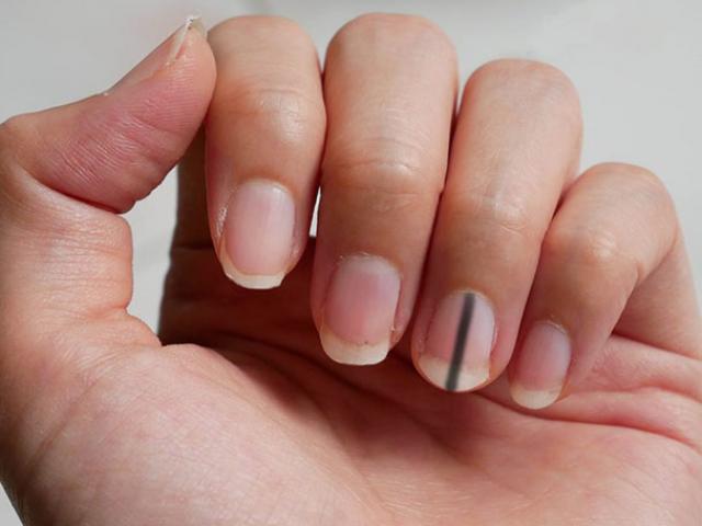 Sức khỏe đời sống - Người phụ nữ choáng váng khi biết vết hằn dưới móng tay tồn tại suốt cả thập kỷ là do ung thư