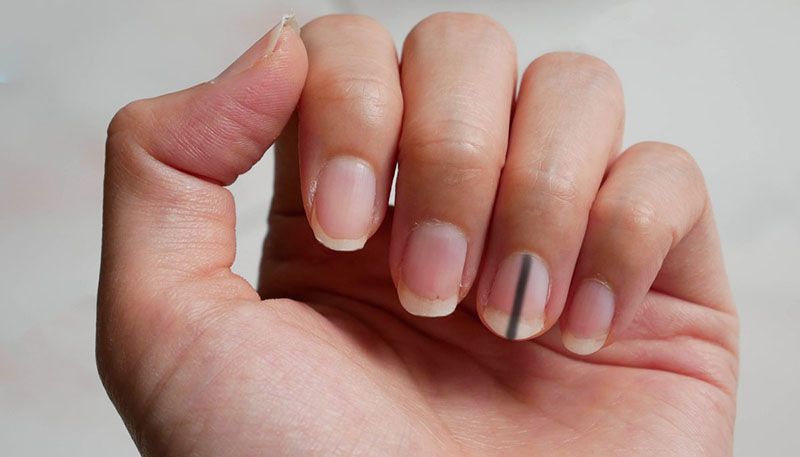 The woman was shocked to learn that the mark under her nails that lasted for a decade was due to cancer - 1
