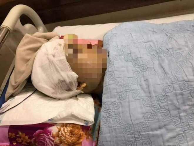 Phó Chủ tịch UBND xã An Thượng bị đánh vỡ hộp sọ, đang phải nhập viện điều trị