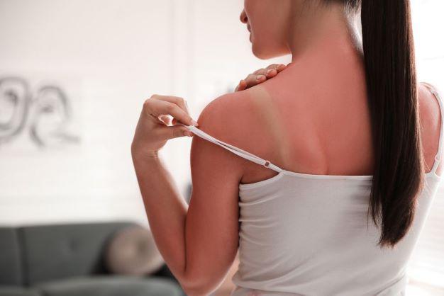 Tips for effective sunburn treatment - 1