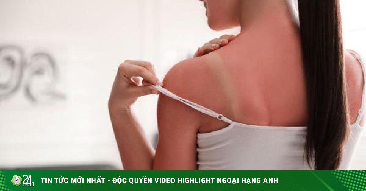 Tips for effective sunburn treatment-Beauty