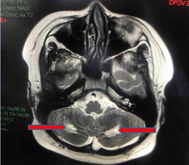 Bệnh nhi bị tổn thương não hiếm gặp hậu COVID-19 - 1