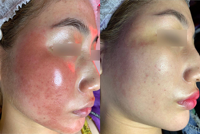 Khắc phục hậu quả bỏng rát vì điều trị nám sai cách cho bệnh nhân sau 01 liệu trình Mezoplus