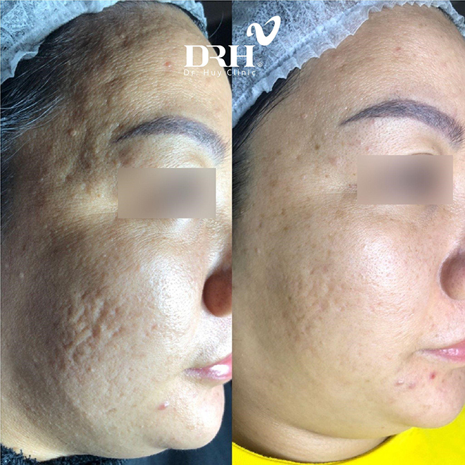 Không chỉ nám, Mezoplus còn mang đến hiệu quả vượt trội trong điều trị sẹo rỗ chỉ sau 01 liệu trình