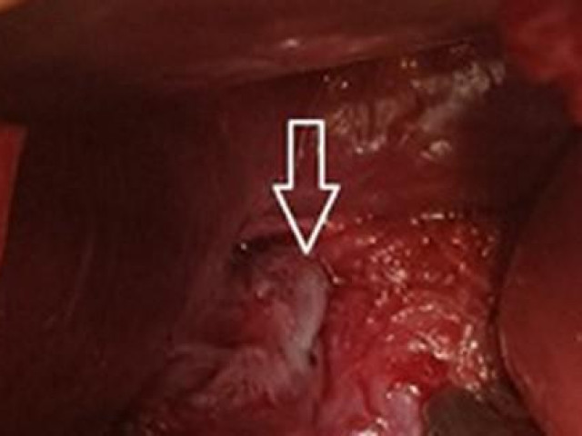 Sức khỏe đời sống - Người đàn ông nhậu, ói đến mức vỡ thực quản