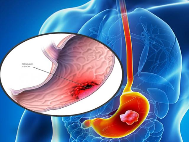 Sức khỏe đời sống - Bác sĩ bệnh viện K giải đáp mọi vấn đề về ung thư dạ dày