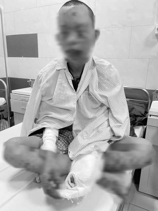 Nam thanh niên nhập viện trong tình trạng mất thị lực, cháy sém toàn thân - Ảnh: Đỗ Hằng