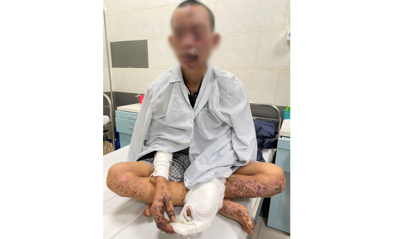 Bệnh nhân N.T được chăm sóc, điều trị tại Bệnh viện Bạch Mai do mất thị lực, cháy sém toàn thân và tổn thương nhiều cơ quan.