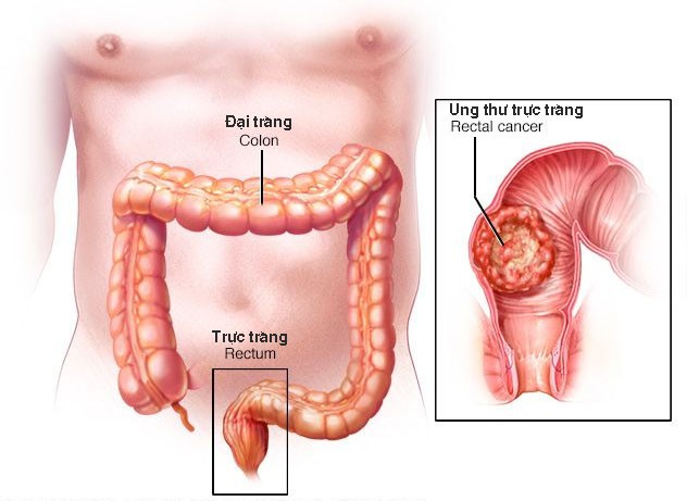 Phó Giám đốc BV K giải đáp mọi thắc mắc về bệnh ung thư đại tràng - 1