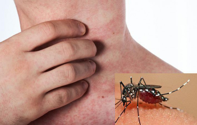 Dengue fever has an increased risk, the warning signs of the disease must not be subjective - 1