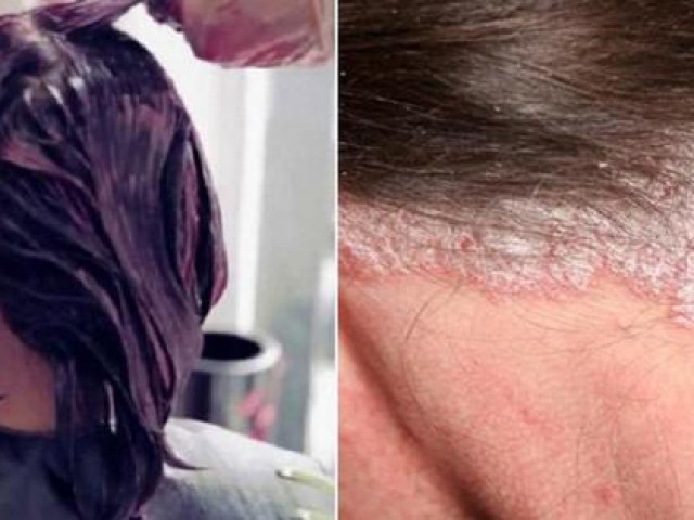 Những lưu ý tránh tóc ”ướp hóa chất” rụng cả mảng, sưng tấy da đầu khi làm đẹp đón Tết