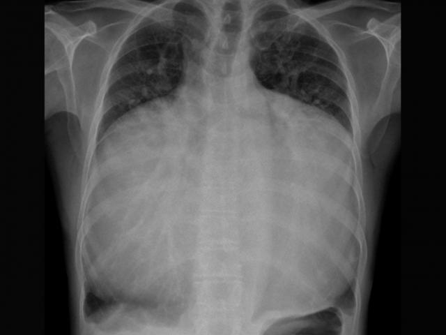 Sức khỏe đời sống - Hi hữu: Người đàn ông có trái tim phình to, lấp đầy cả khoang ngực