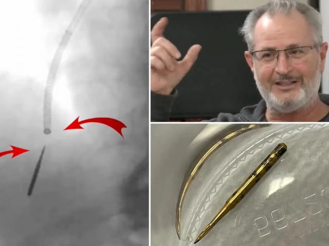 Sức khỏe đời sống - Người đàn ông suýt cắt bỏ 1 phần phổi vì hít phải mũi khoan khi làm răng