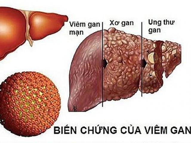 Bác sỹ Bệnh viện K điểm mặt dấu hiệu, nguyên nhân của ung thư gan