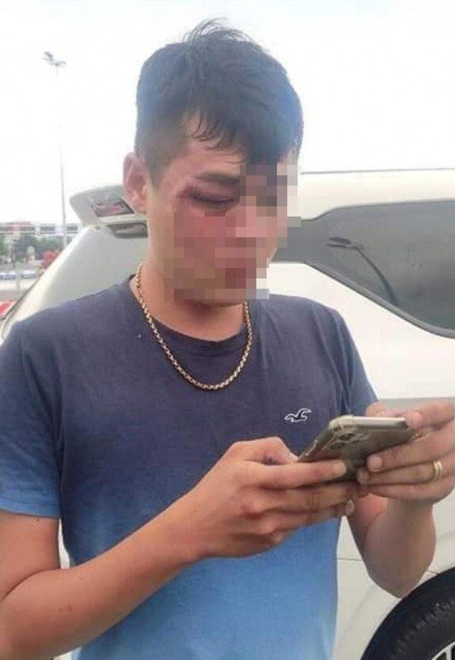 Nam tài xế bị thương tích sau khi bị hành hung. Ảnh: H.H