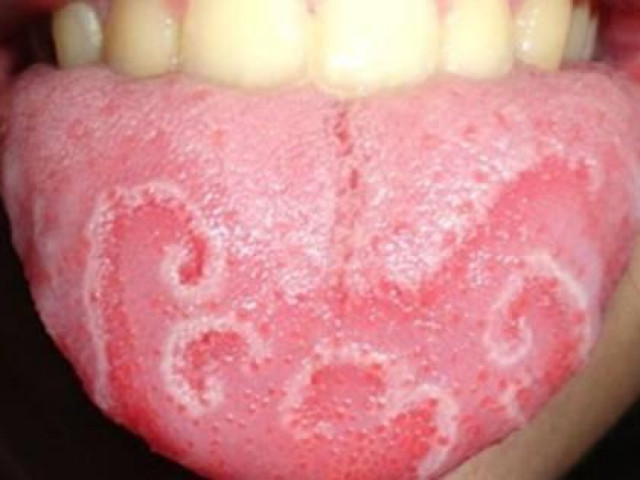 Sức khỏe đời sống - Những dấu hiệu bất thường ở lưỡi cảnh báo bệnh lý nguy hiểm