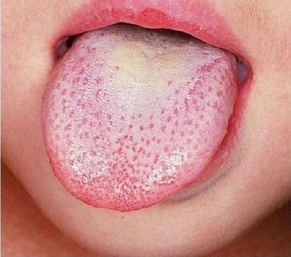 Abnormal signs on the tongue warn of dangerous diseases - 2