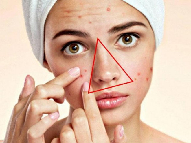 Squeezing acne seems to be a simple task, but many people still experience complications, even life-threatening, because of this mistake - 3