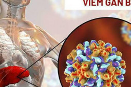 Sức khỏe đời sống - Nhiễm virus viêm gan B sau bao lâu thì xuất hiện triệu chứng và tiến triển thành ung thư gan?