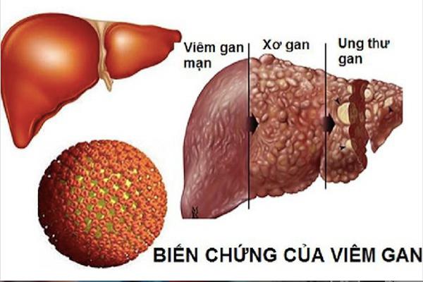 Bến chứng của viêm gan B mạn tiến triển xơ gan, ung thư gan.