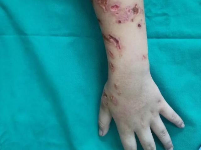 Sức khỏe đời sống - Sứa đốt chằng chịt trên cơ thể bé trai sau khi tắm biển Hạ Long