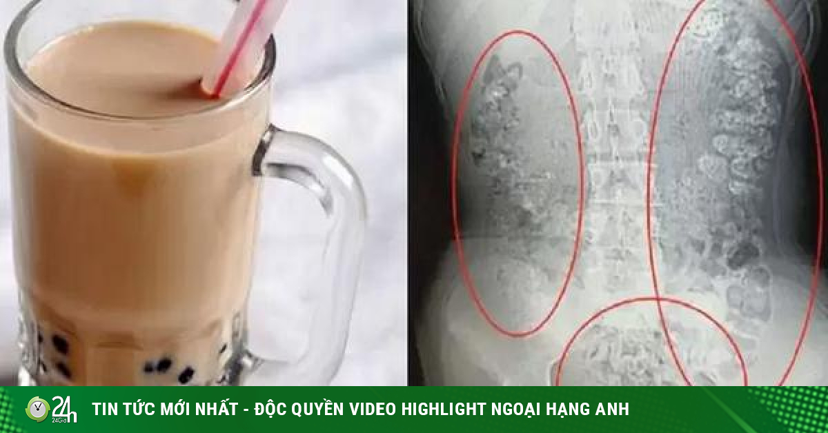 From the case of a female student being hospitalized after drinking milk tea, experts warn that after drinking 1 cup of milk tea, you must do it