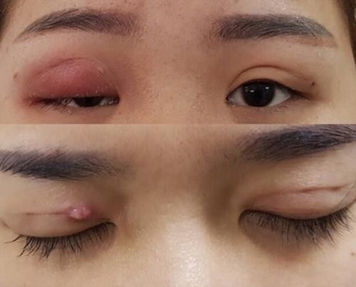 Cắt mí hỏng tại cơ sở thẩm mỹ không uy tín