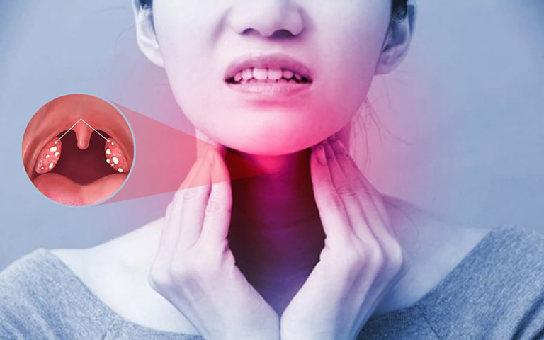 Chronic pharyngitis due to gastroesophageal reflux - The pain can't find a way out, why?  - 3