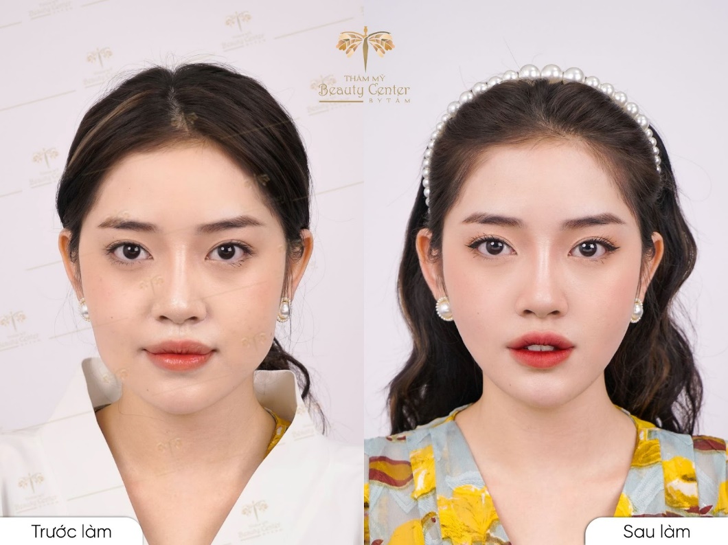 Mẫu ảnh Lookbook Dạ Minh Nguyệt chia sẻ:” Đặc thù nghề nghiệp của Nguyệt là mẫu ảnh nên mặt phải chuẩn Vline nhỏ gọn, các đường nét hài hòa sắc nét thì lên ảnh mới có thể xinh được. Khuôn mặt nhỏ gọn hiện tại đúng với mong muốn của mình. Mình thực sự rất mừng”.