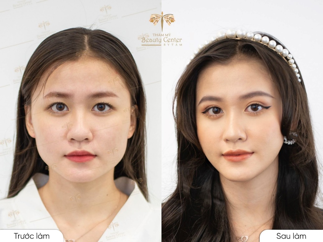 "Khuôn hàm của mình hiện tại đã nhỏ lại rất nhiều, phần cơ và mỡ gần như không có nữa, kết quả còn ngoài sự mong đợi, thực sự rất bất ngờ, mình cảm thấy tự tin và xinh đẹp hơn".