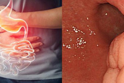 Sức khỏe đời sống - Chỉ đầy bụng, khó tiêu, đi khám đã biết mình mắc ung thư dạ dày, chuyên gia chỉ rõ 6 dấu hiệu điển hình nhất định phải khám sớm