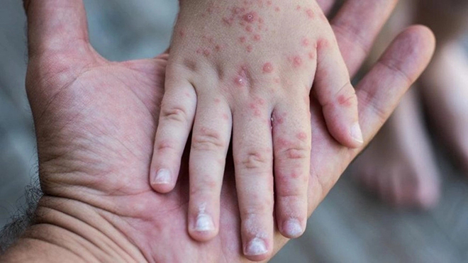 Hand, foot and mouth disease 