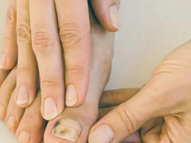 Sức khỏe đời sống - Phát hiện mắc ung thư nhờ điểm lạ ở ngón chân, chuyên gia cho biết người phụ nữ này "thật may mắn", dù đó là khối u ác tính