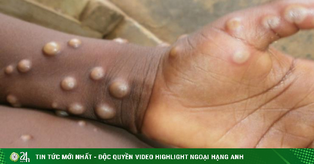 Monkeypox can be transmitted from person to person – Life Health