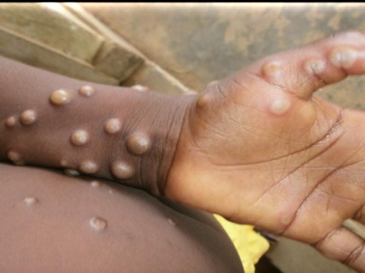 How to identify a person with monkeypox?  - first