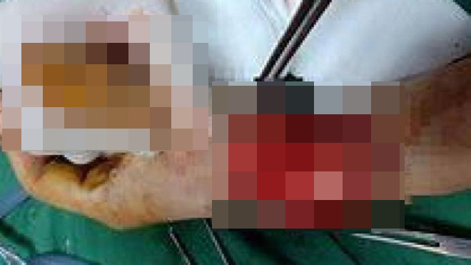 Anh Phạm Văn Hoàng Vũ bị chém đứt gần lìa ngón tay cái.