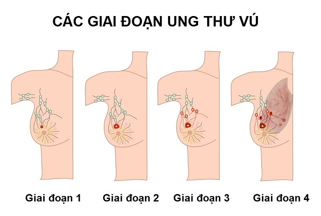 Những sai lầm khi mắc ung thư khiến “nàng Lâm Đại Ngọc” Trần Hiểu Húc phải trả giá đắt - 7