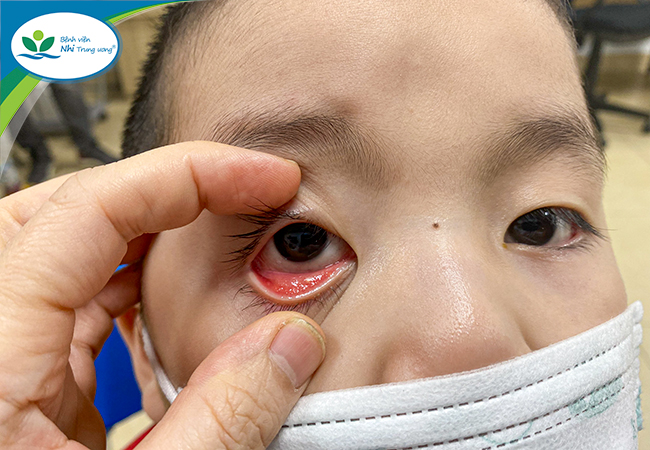 Hậu COVID-19, trẻ bị đau mắt đỏ, cộm mắt: Cha mẹ cần chú ý những dấu hiệu để đi khám - 1