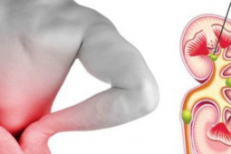 Sức khỏe đời sống - Thay đổi 8 thói quen dưới đây giúp bạn tránh xa sỏi thận