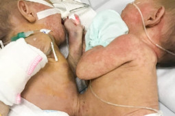 Sức khỏe đời sống - Cặp song sinh dính liền hiếm gặp, 200.000 trẻ mới gặp 1 ca