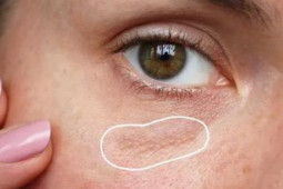 Làm đẹp - Mụn thịt chữa cách gì?