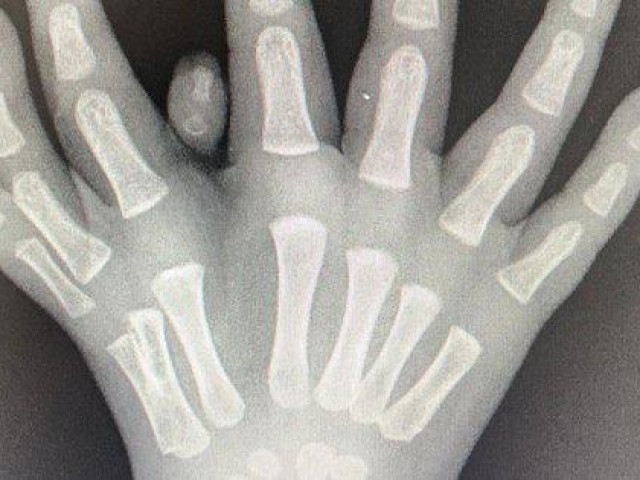 Sức khỏe đời sống - Bé trai có bàn tay 8 ngón hiếm gặp