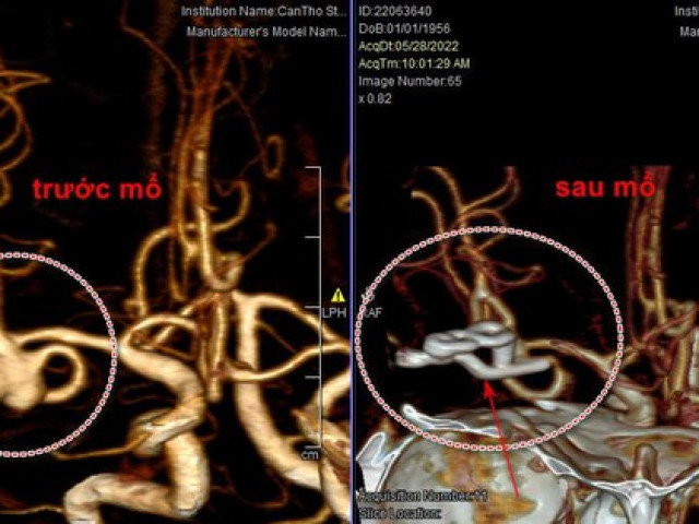 Sức khỏe đời sống - Cất cao giọng khi hát karaoke, "ca sĩ" vỡ mạch máu não