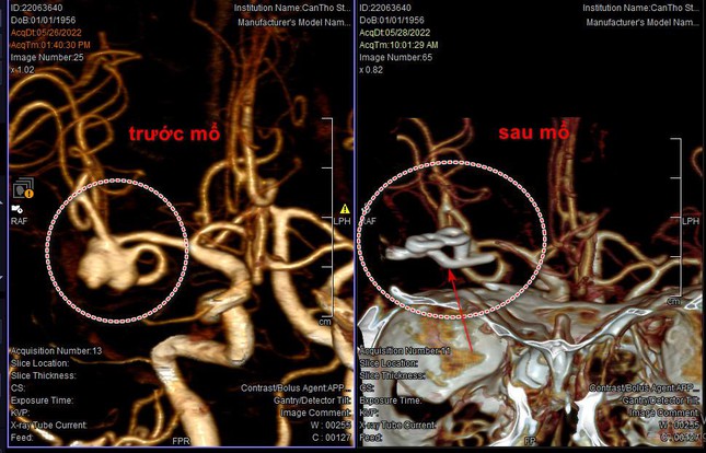 Túi phình mạch máu não của bệnh nhân đã bị vỡ khi huyết áp&nbsp;tăng cao (hình bên trái)