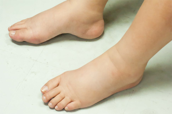 5 signs in the feet that liver disease is silently progressing - 4