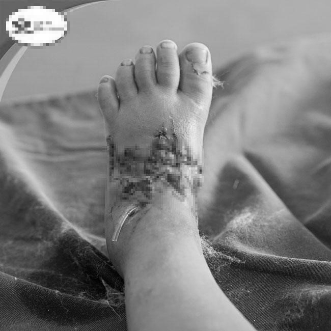Em bé 2 tuổi bị nát bàn chân do kẹp vào cổng trượt tự động - Ảnh: Bệnh viện cung cấp